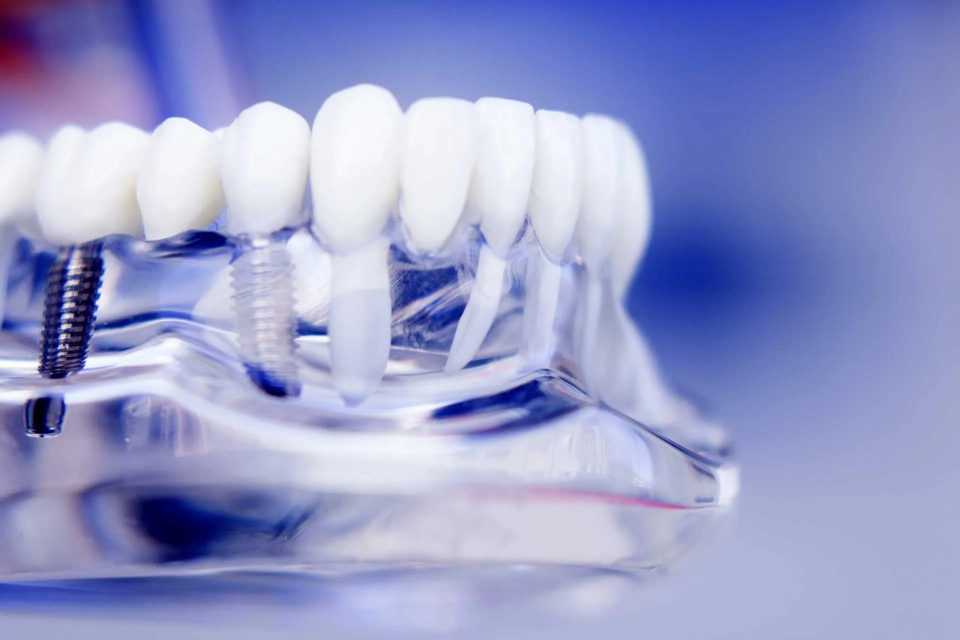 Multiple teeth implants