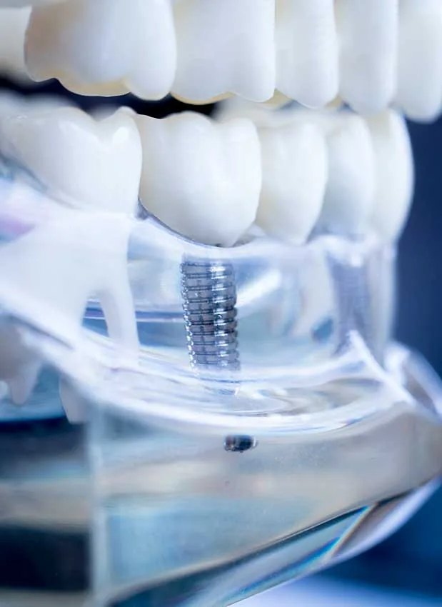 Dental implant procedure at HAHS Clinic