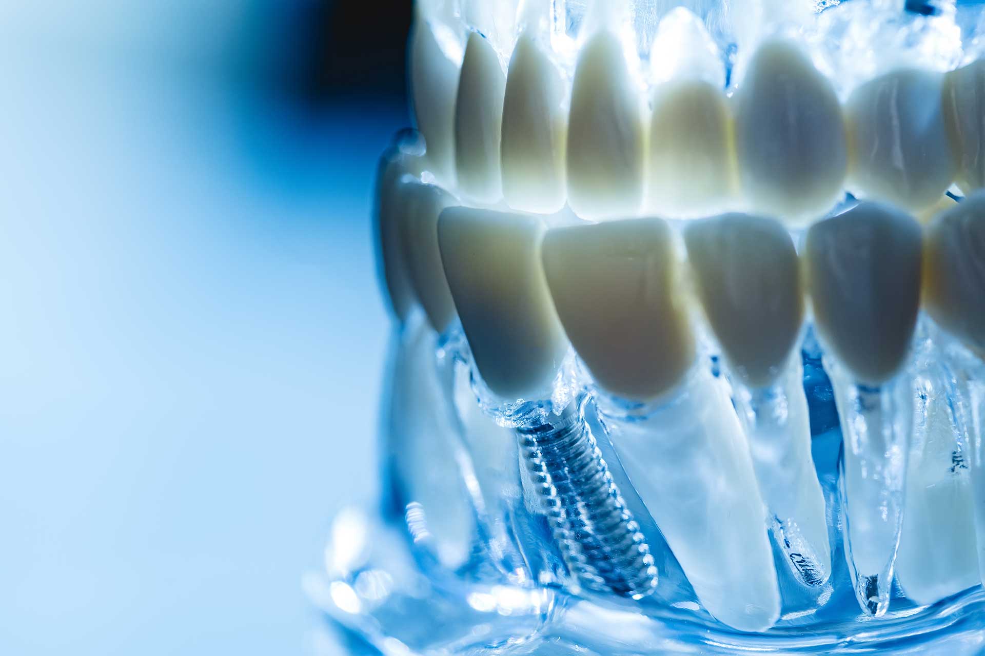 Full arch dental implants