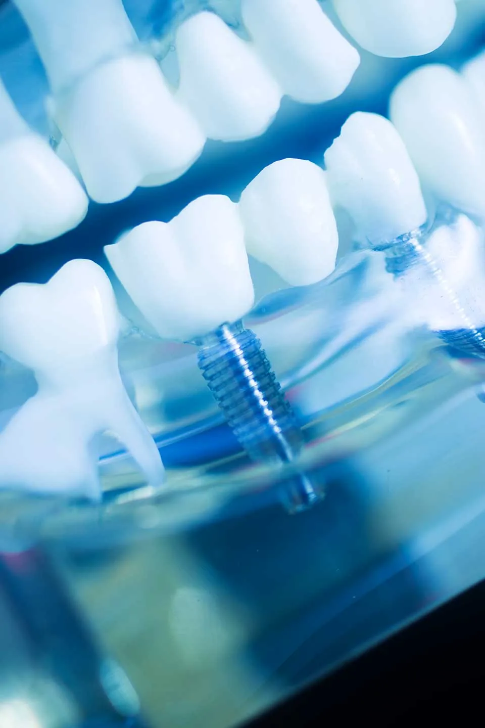 Single tooth implant