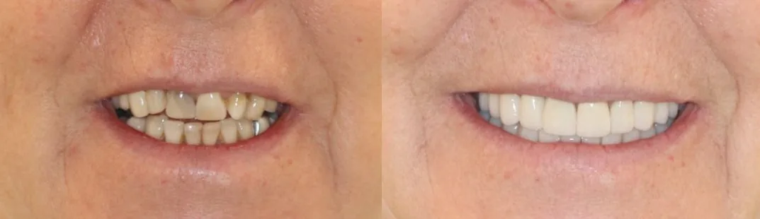Full mouth rehabilitation — before and after