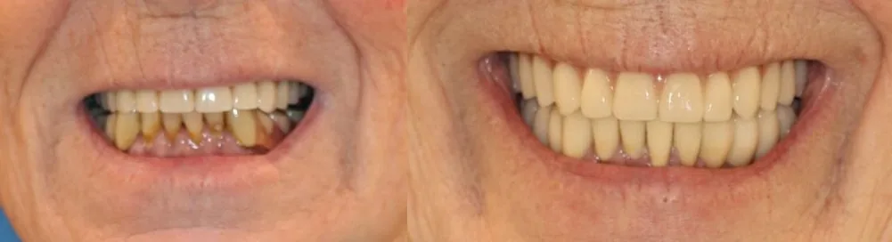 Dental implants — before and after