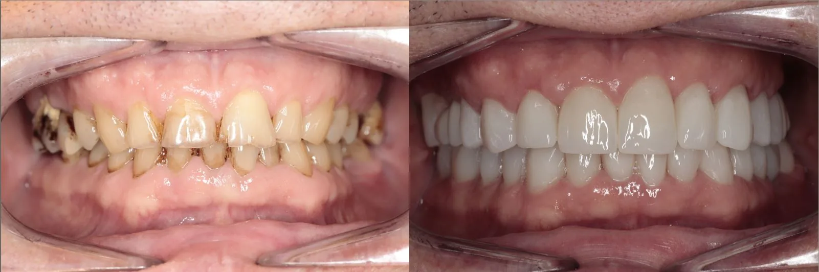 Smile makeover — before and after