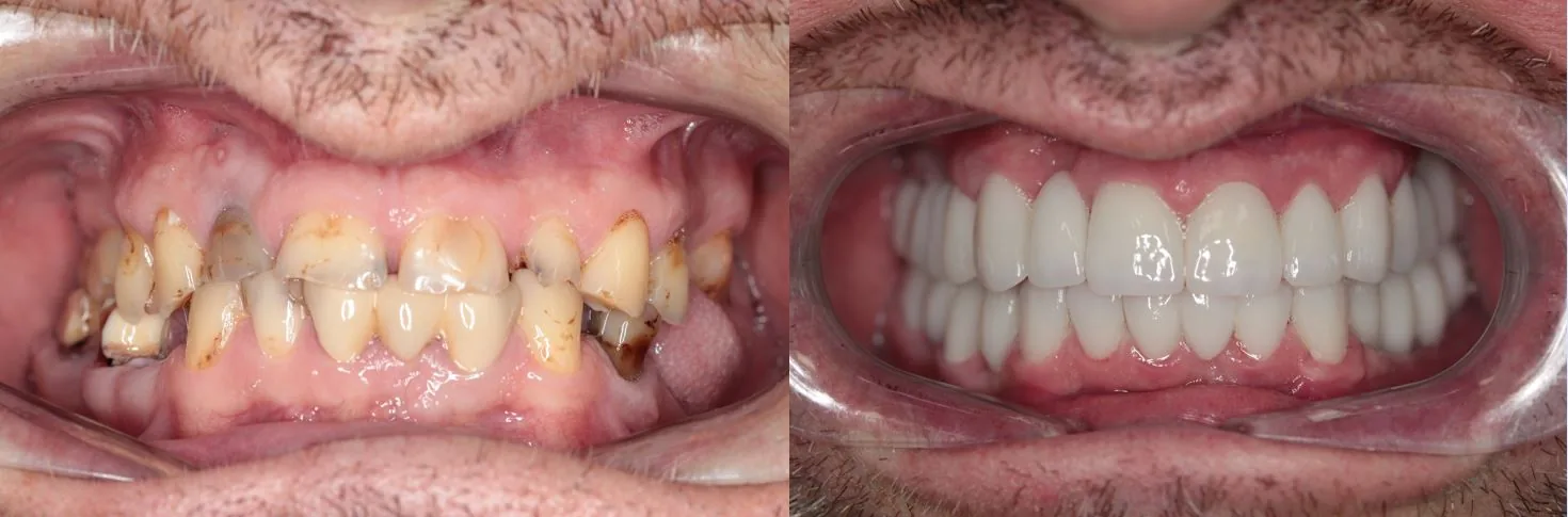 Advanced implantology — before and after