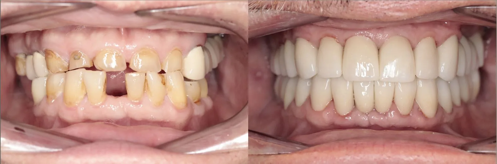 Full arch restoration — before and after